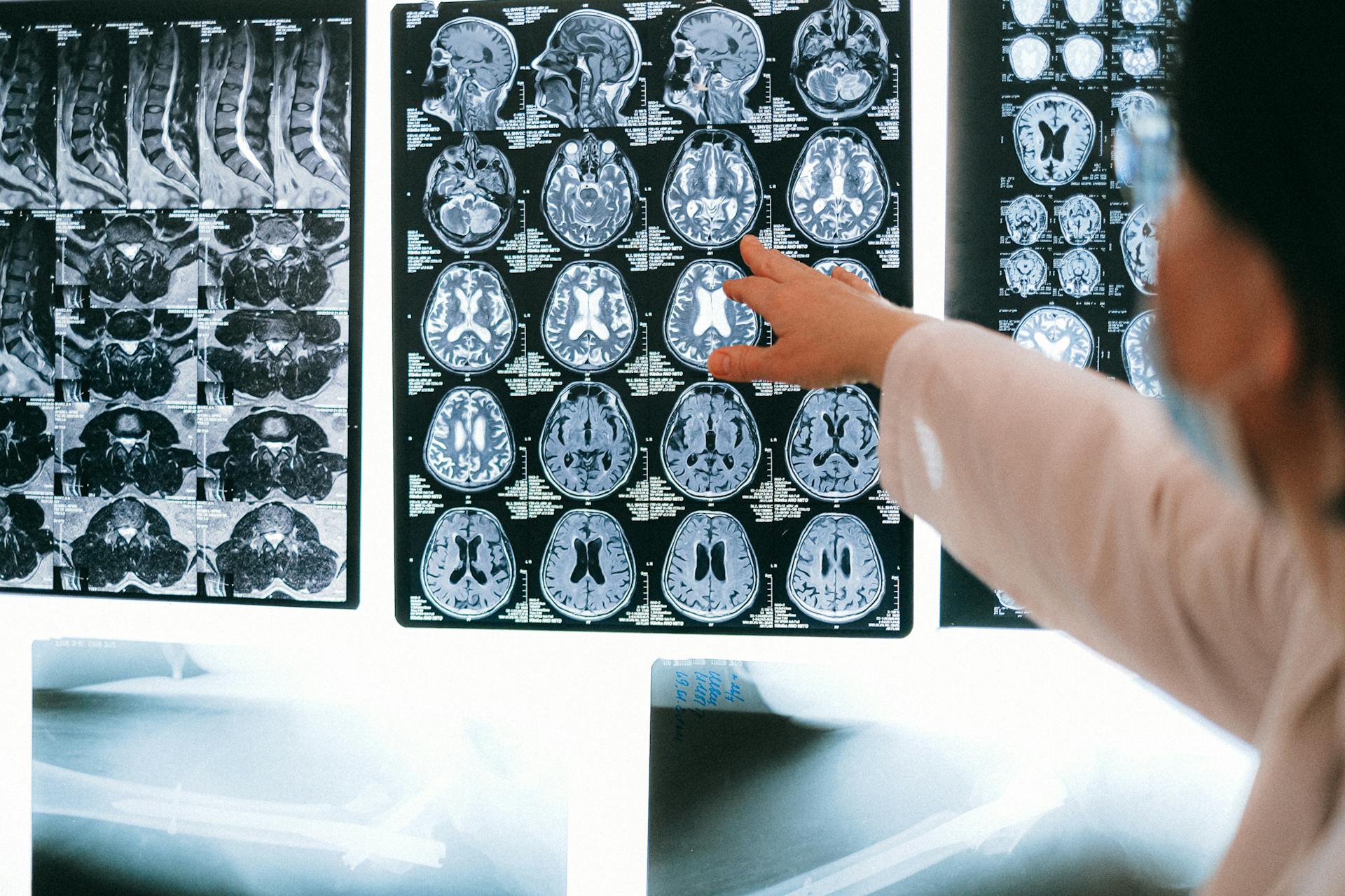 Healthcare professional pointing at a series of detailed MRI brain scans on a light board, illustrating a key part of a career as a radiologic technologist.